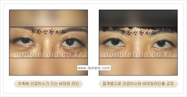 [두한성형외과 경쟁력 쌍꺼풀 재수술, 극한 눈 재수술] - [안검하수(졸리운 눈매) 재수술 안내] 관련 이미지 6