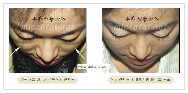 ⁠⁠[두한성형외과 경쟁력 미세지방이식] - [미세지방이식을 이용한 귀족수술 + 인디언밴드 시술 안내] 관련 이미지 5