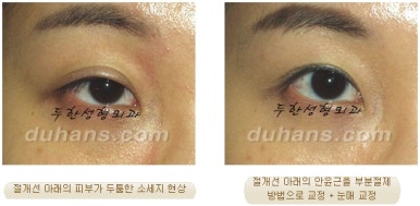 Best Place for Revision Eyelid Surgery, Duhan Plastic Surgery - Lowering Double Eyelid Line image 26