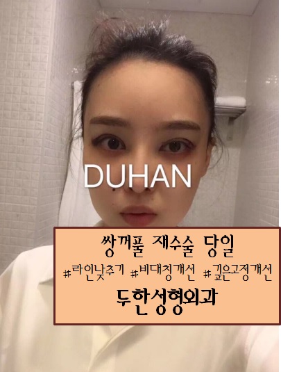 [두한성형외과] - [쌍꺼풀재수술, 눈재수술, 쌍꺼풀라인낮추기, 볼지방흡입, V라인] 관련 이미지 3