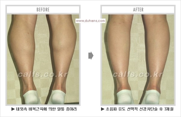 [두한성형외과 경쟁력 멀티종아리성형] - [알통종아리 해결 - 비절개 초음파 선택적 신경차단술] 관련 이미지 19