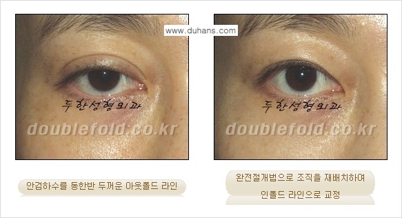 [두한성형외과 경쟁력 쌍꺼풀 재수술, 극한 눈재수술] - [심한 아웃폴드 라인을 인폴드 라인으로 교정 방법 안내] 관련 이미지 5