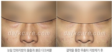 [두한성형외과 다크서클 수술방법] - [NO흉터 눈밑지방제거] 관련 이미지 7