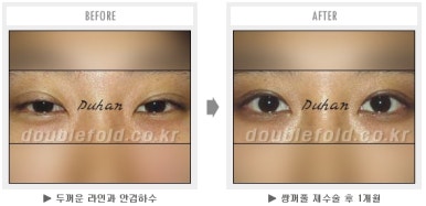 두한성형외과 쌍커풀 재수술 - 짝눈 눈매교정, 가성 안검하수 교정과 뒤밑트임 관련 이미지 54
