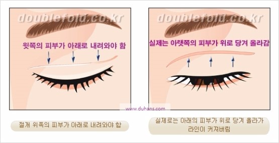 [두한성형외과 경쟁력 눈성형] - [쌍꺼풀 재수술에 대한 최선의 대안 제시] 관련 이미지 6