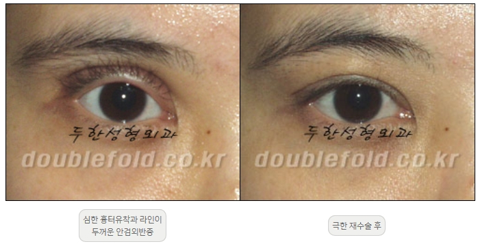 [Double Eyelid Surgery, Duhan Plastic Surgery] - [Extreme Revision Eye Surgery to Correct a Damaged Line] image 15