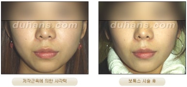 [Duhan Plastic Surgery Clinic Aesthetic Procedures] - [Square Jaw Botox] image 5