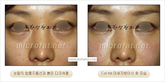 [두한성형외과 경쟁력 눈밑성형] - [눈밑 미세지방이식으로 다크써클 치료] 관련 이미지 17