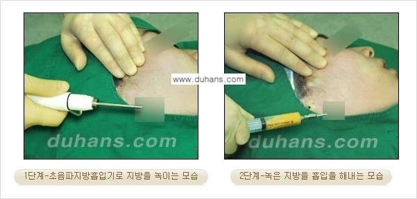 ​​​﻿[두한성형외과 경쟁력 간편지방흡입] - [볼살지방흡입, 턱선지방흡입 시술 과정의 안내] 관련 이미지 5