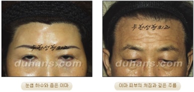 Duhan Plastic Surgery Forehead Surgery - Forehead Lifting Endotine Lifting image 2