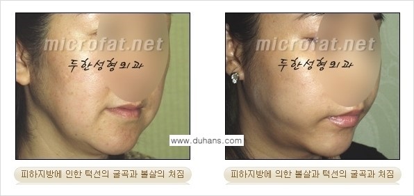 [두한성형외과 경쟁력 지방흡입] - [얼굴 지방흡입 부작용 교정방법 안내] 관련 이미지 3