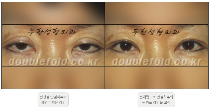 [Ptosis, Duhan Plastic Surgery] - [Sleepy-Looking Eyes, Ptosis Eye Correction] image 18