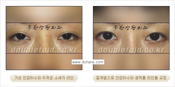 [두한성형외과 NO.1 "극한 눈(쌍꺼풀 재수술)"] - [안검하수(졸린눈매) 재수술 안내 3.] 관련 이미지 4