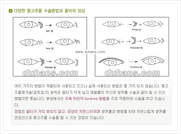 [두한성형외과 경쟁력 눈성형] - [앞트임 수술(몽고주름 제거) 안내 ①] 관련 이미지 8