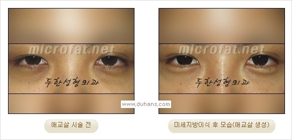 [두한성형외과 경쟁력 눈밑성형] - [타 병원 필러 애교살 시술 부작용을 미세지방이식으로 교정] 관련 이미지 18