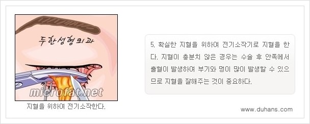 [두한성형외과 경쟁력 지방제거] - [눈밑(눈위)지방제거, 눈꺼풀(윗눈꺼풀)지방제거 안내 ①] 관련 이미지 9