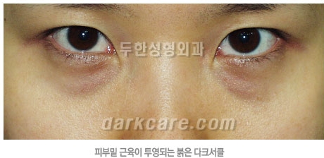 Duhan Plastic Surgery Dark Circle Improvement - What Causes Dark Circles? What Types of Dark Circles Are There? image 18