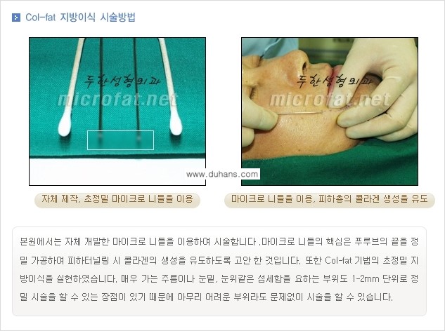 [두한성형외과 경쟁력 미세지방이식] - [Col-fat(콜펫) 지방이식의 특징과 차이점 안내] 관련 이미지 2
