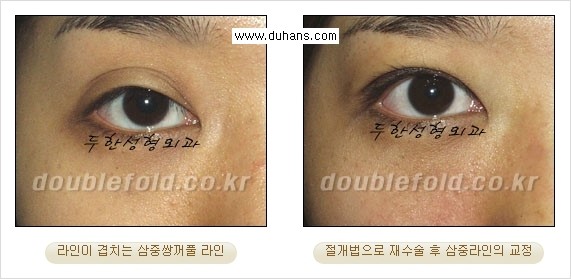 [두한성형외과 경쟁력 눈성형] - [삼중(세겹) 쌍꺼풀 라인의 교정] 관련 이미지 8