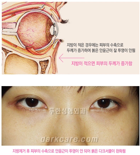 [두한성형외과 다크서클 수술방법] - [NO흉터 눈밑지방제거] 관련 이미지 5
