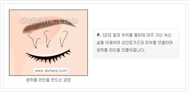 [두한성형외과 경쟁력 눈성형] - [퀵쌍꺼풀 안내] 관련 이미지 10
