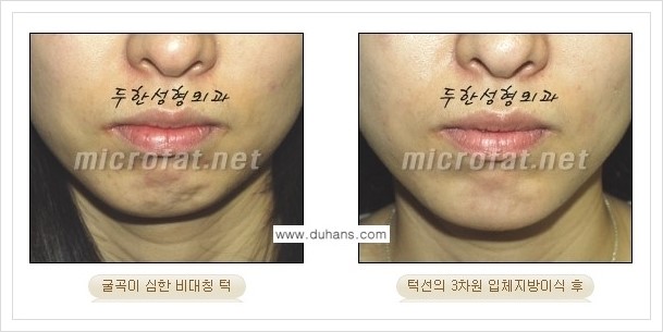[두한성형외과 경쟁력 안면윤곽 교정] - [미세지방이식으로 무턱, 작은턱, 오목턱, 턱선의 비대칭 교정 안내] 관련 이미지 7