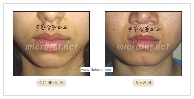 ⁠⁠[두한성형외과 경쟁력 미세지방이식] - [턱 미세지방이식 - 안면윤곽 교정 안내] 관련 이미지 1