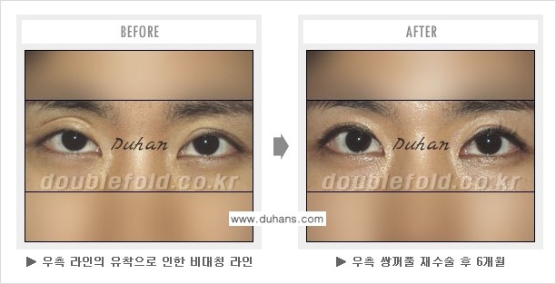[두한성형외과 쌍꺼풀 재수술] - [지나친 아웃폴드 라인의 쌍꺼풀 재수술] 관련 이미지 7