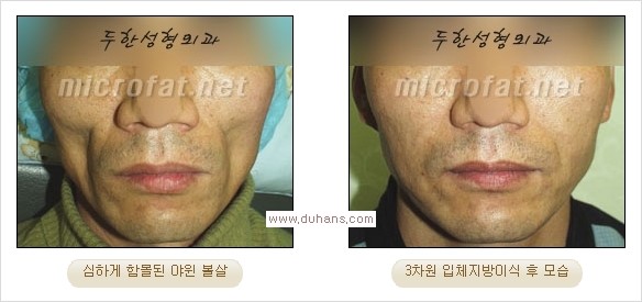 [두한성형외과 경쟁력 미세지방이식] - [볼살, 이마, 측두부 - 안면윤곽 미세지방이식] 관련 이미지 11