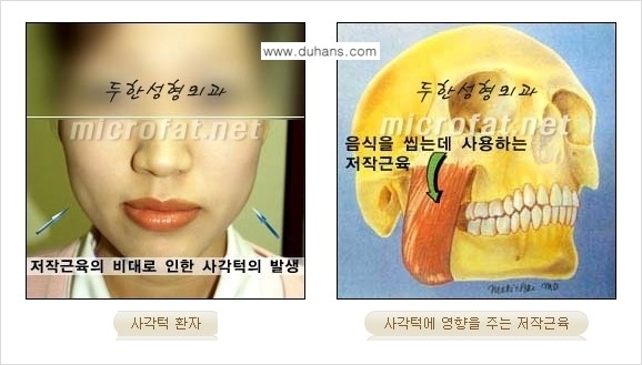 [두한성형외과 경쟁력 안면윤곽성형] - [보톡스(보툴리눔톡신)에 의한 사각턱 교정] 관련 이미지 2