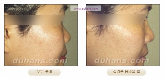 [두한성형외과 경쟁력 코성형 리더] - [자연스럽고 오똑한 콧망울! 코성형 방법]​ 관련 이미지 15