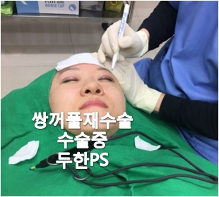 [두한성형외과-쌍꺼풀 재수술] #인아웃라인#쌍꺼풀재수술 관련 이미지 2