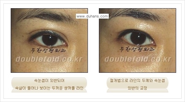 [두한성형외과 경쟁력 쌍꺼풀 재수술, 극한 재수술] - [속눈썹 외반 수술 방법 안내] 관련 이미지 5