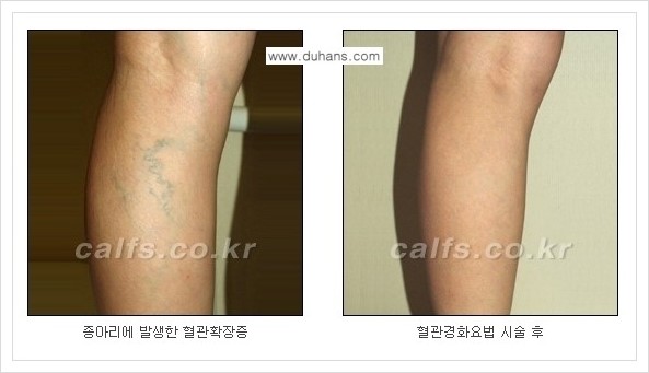 [두한성형외과 경쟁력 멀티종아리성형] - [나에게 맞는 종아리성형 방법의 종류 안내 3.] 관련 이미지 13