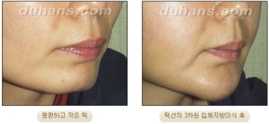 [Duhan Plastic Surgery Micro Fat Grafting] - [Receded Chin, Small Chin, Cleft Chin, Chin Line Asymmetry Correction] image 11