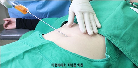 [눈밑수술 두한성형외과] - [다크서클 콤비프로그램] 관련 이미지 97