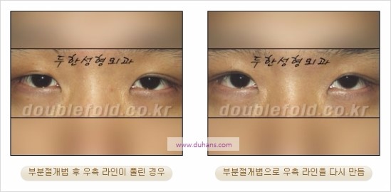 [두한성형외과 경쟁력 눈성형] - [비대칭 쌍꺼풀 라인의 여러 가지 교정 방법] 관련 이미지 9