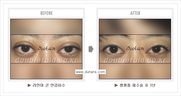 [두한성형외과 경쟁력 쌍꺼풀 재수술] - [여러번의 쌍꺼풀 재수술로 인한 흉살이 두터운 경우 안내] 관련 이미지 2