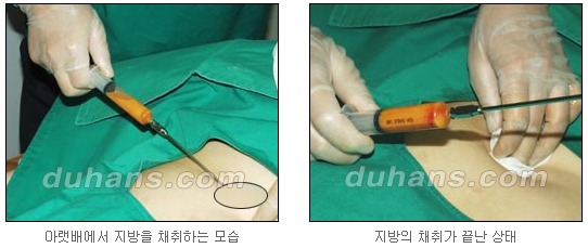 [두한성형외과 주름개선] - [주름교정 방법] 관련 이미지 48