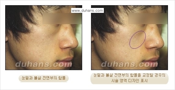 ⁠[두한성형외과 경쟁력 미세지방이식] - [귀족수술 - 입체미세지방이식 ①] 관련 이미지 6