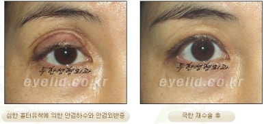 Duhan Plastic Surgery Ophthalmic Reoperation - What Is a Successful Double Eyelid Revision Surgery? image 14