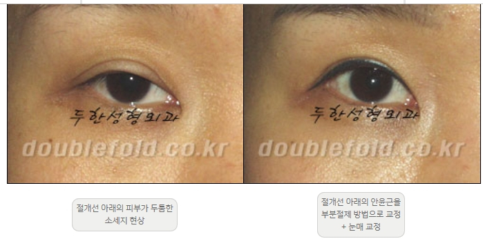 [Double Eyelid Surgery Duhan Plastic Surgery] - [Revision Methods] image 16