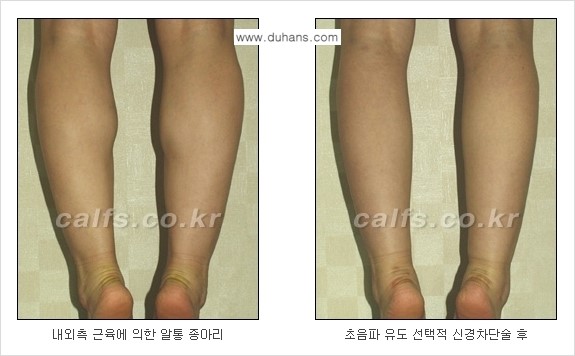 ​[두한성형외과와 날씬한 종아리 만들기!] - [간편하고 안전한 종아리 축소방법 ④] 관련 이미지 10