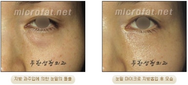 Facial Fat Liposuction at Duhan Plastic Surgery - Cheek Fat Liposuction, Jawline Liposuction, Under-Eye Fat Liposuction image 35