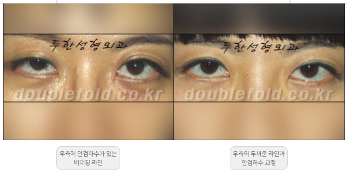 [두한성형외과 쌍커플재수술] - [비대칭 쌍커풀 라인] 관련 이미지 9