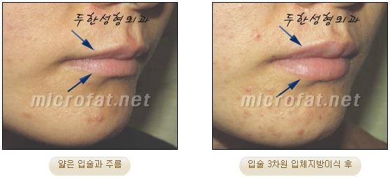 [Duhan Plastic Surgery Lip Surgery] - [Lip Correction Fat Grafting] image 14