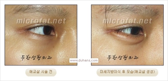 [두한성형외과 경쟁력 눈밑성형] - [타 병원 필러 애교살 시술 부작용을 미세지방이식으로 교정] 관련 이미지 31