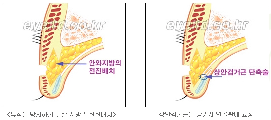 [Duhan Plastic Surgery Secondary Double Eyelid Surgery] - [Sleepy Eye Appearance, Asymmetrical Eye Appearance, Ptosis] image 8