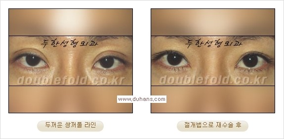 [두한성형외과 경쟁력 쌍꺼풀 재수술] - [쌍꺼풀 재수술 과정] 관련 이미지 69