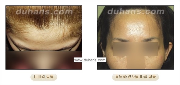 [두한성형외과 경쟁력 미세지방이식] - [볼살, 이마, 측두부 - 안면윤곽 미세지방이식] 관련 이미지 1